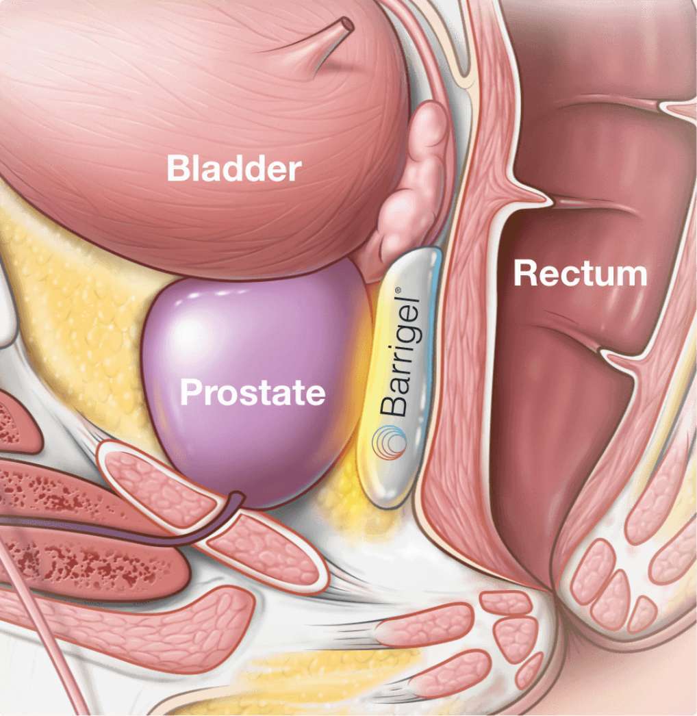 about-the-procedure-with-spacer about-the-procedure-with-spacer